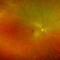 Retinal Optomap Imaging