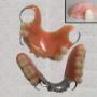 Partial upper acrylic denture and partial lower cast metal denture, with a 1-tooth flipper inset Partial upper acrylic denture and partial lower cast metal denture, with a 1-tooth flipper inset