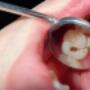 Tooth Cavity Fillings in Mississauga - Tooth cavity magnified by a dental examination magnifier Tooth Cavity Fillings in Mississauga - Tooth cavity magnified by a dental examination magnifier