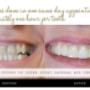 CEREC CROWN REPAIR CEREC CROWN REPAIR