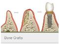 Bone Grafts