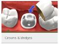 Crowns-and-Bridges