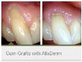 Gum Grafts with AlloDerm