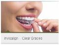 Invisalign-Clear-Braces