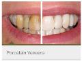 Porcelain-Veneers