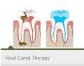 Root-Canal-Therapy