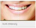 Teeth-Whitening