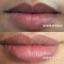 Les produits injectables de comblement des rides peuvent rafraîchir votre visage. Un regard plus jeune et plus reposé sans anesthésie ni bistouri. Des injections de Botox ou de Fillers en faible quantité peuvent avoir un effet préventif. Les produits injectables de comblement des rides peuvent rafraîchir votre visage. Un regard plus jeune et plus reposé sans anesthésie ni bistouri. Des injections de Botox ou de Fillers en faible quantité peuvent avoir un effet préventif.