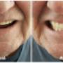 Before - Dentures were 10+ years old, made after a full clearance of lower dentition.
After - New complete upper & lower dentures, made in June 2016. Before - Dentures were 10+ years old, made after a full clearance of lower dentition.
After - New complete upper & lower dentures, made in June 2016.