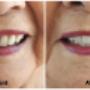 Before - Dentures had required multiple relines and repairs. Dentures showed severe wear, staining, poor fit, patient was unhappy with aesthetics, and lower denture was fractured.
After - New complete upper & lower dentures, made June 2017. Before - Dentures had required multiple relines and repairs. Dentures showed severe wear, staining, poor fit, patient was unhappy with aesthetics, and lower denture was fractured.
After - New complete upper & lower dentures, made June 2017.