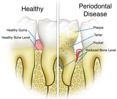 Periodontal-Disease