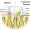 Periodontal-Disease