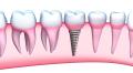 Dental implants and dental bone grafts