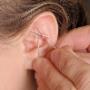 Ear Acupuncture Ear Acupuncture