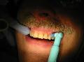 Dental-Cleaning