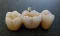Dental Crown