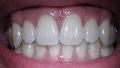 Teeth Whitening