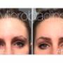 Elle avait une ligne de sourcils asymétrique et désirait remettre ses sourcils plus égale et défini. Elle avait une ligne de sourcils asymétrique et désirait remettre ses sourcils plus égale et défini.