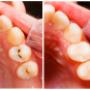 gum graft gum graft