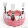 Chargé par visiteur le 2018-10-03 - periodontal flap surgery Chargé par visiteur le 2018-10-03 - periodontal flap surgery