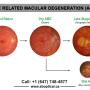 Age-Related-Macular-Degeneration. Age-Related-Macular-Degeneration.