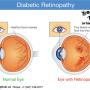 DIABETIC RETINOPATHY DIABETIC RETINOPATHY