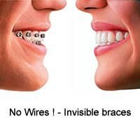 BRACES VANCOUVER - INVISALIGN