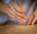 Acupuncture