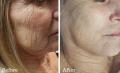 Microneedling