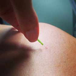Wellpoint Acupuncture
