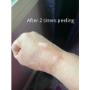 After two times peeling After two times peeling