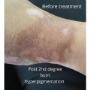 Post 2nd degree burn hyperpigmentation Post 2nd degree burn hyperpigmentation