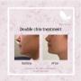 Double Chin Treatment (Before and After) Double Chin Treatment (Before and After)