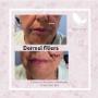Dermal Fillers (Before and After) Dermal Fillers (Before and After)