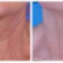 Skin tightening treatments Skin tightening treatments