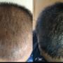 Hair growth results with micro-needling Hair growth results with micro-needling