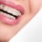 Braces
