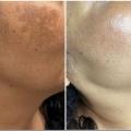Removal Treatments for Melasma & Other Forms of Hyperpigmentation