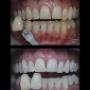 Before and after photo's from the Sparkle Package. Two back-to-back whitening sessions of 40 mins each. Before and after photo's from the Sparkle Package. Two back-to-back whitening sessions of 40 mins each.