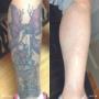 Before & After Calf Tattoo Removal Before & After Calf Tattoo Removal