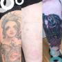 Before & After Shin Tattoo Removal Before & After Shin Tattoo Removal