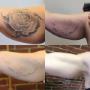 Before & After Upper Arm Tattoo Removal Before & After Upper Arm Tattoo Removal