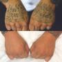 Before & After Hand Tattoo Removal Before & After Hand Tattoo Removal