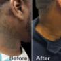 Before & After Neck Tattoo Removal Before & After Neck Tattoo Removal