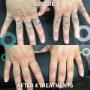Before & After Knuckle Tattoo Removal Before & After Knuckle Tattoo Removal