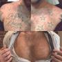 Before & After Chest Tattoo Removal Before & After Chest Tattoo Removal