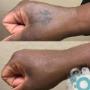 Before & After Hand Tattoo Removal Before & After Hand Tattoo Removal