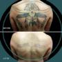 Before & After Back Tattoo Removal Before & After Back Tattoo Removal