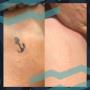 Before & After Tattoo Removal Before & After Tattoo Removal