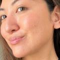 Chemical Peel